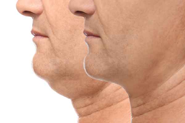 HIFU - Breakthrough in Anti - ageing 2 hifu results Bakewell