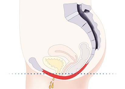 Pelvic-Floor Muscle Repair 5 Pelvic floor muscles Bakewell