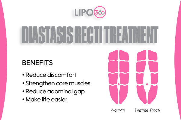 Revolutionising Muscle Repair: The Power of LIPO360 Body Sculpt Post-Injury 5 diastasis recti treatment Bakewell