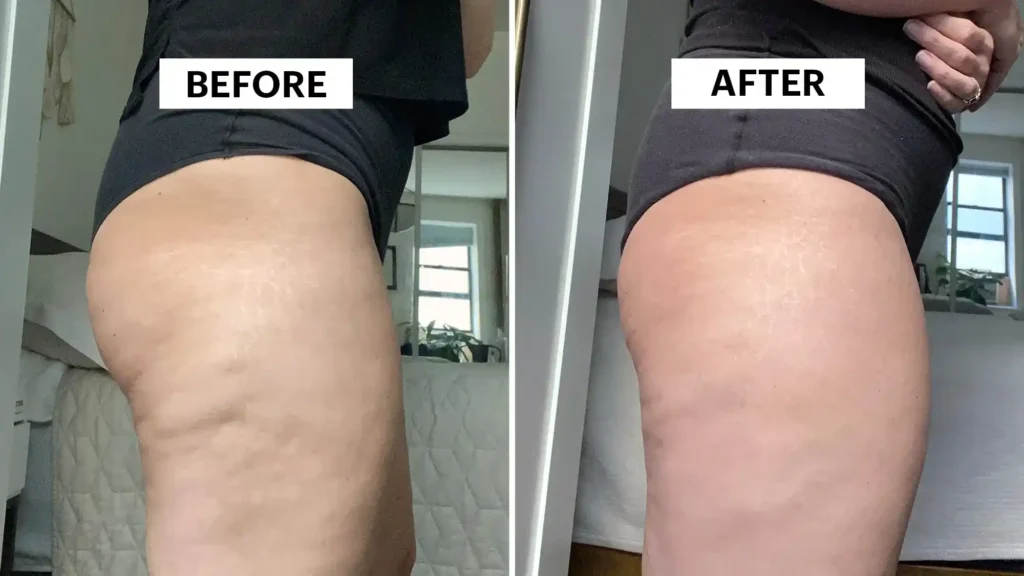 Do Toning Exercise Bakewell Really Tackle Cellulite?