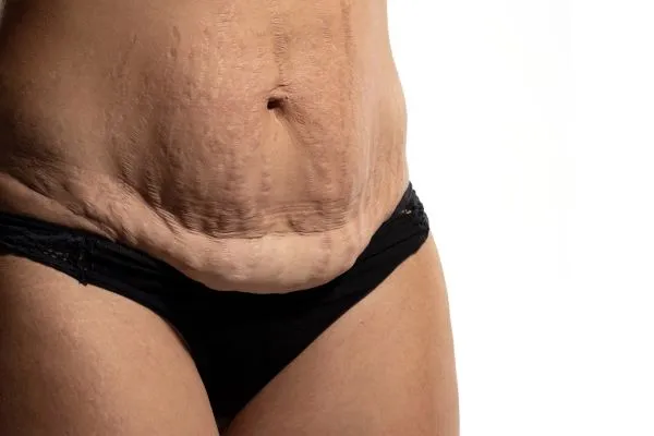 The science behind skin tightening Bakewell picture of a woman's sagging skin on the stomach